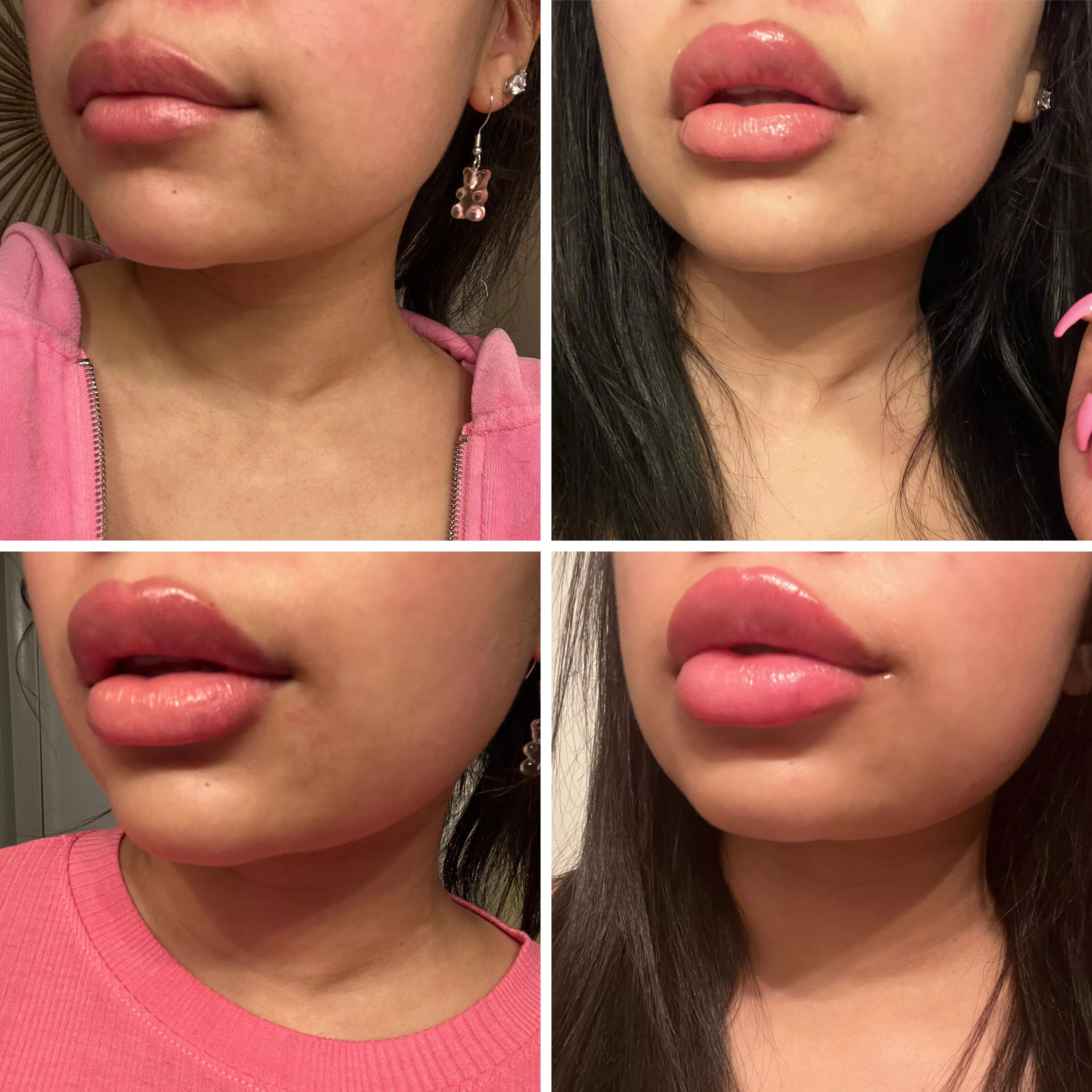 Got another syringe in my lips yesterday! Here’s the evolution of my lips over the past few months posted by xojustbri