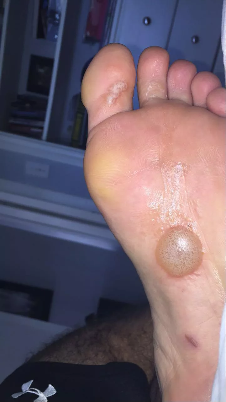 Pic from my recent flare up of Dyshidrotic Eczema posted by GentlemanHere