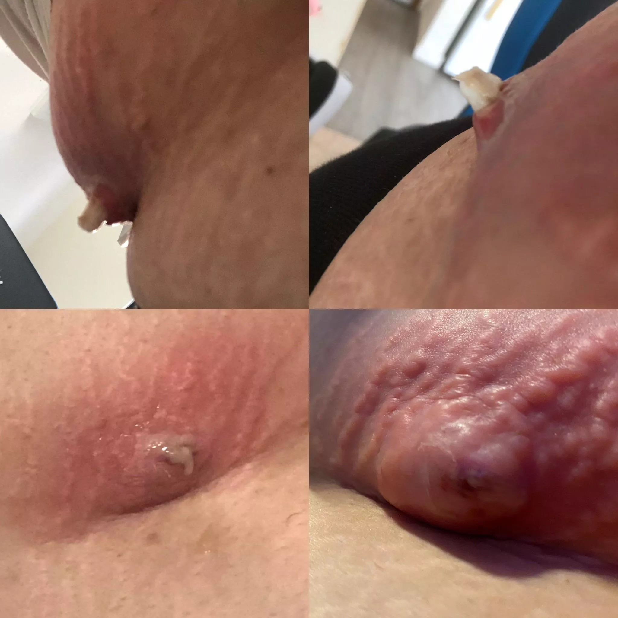 the first 2 are from today, the 4th photo was when it was at its peak and i was screaming from the pain posted by sadgiril