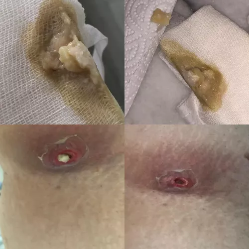 update from yesterday’s post, the big chunks came out when i removed the bandage this morning and i am left with a hole that keeps draining by sadgiril