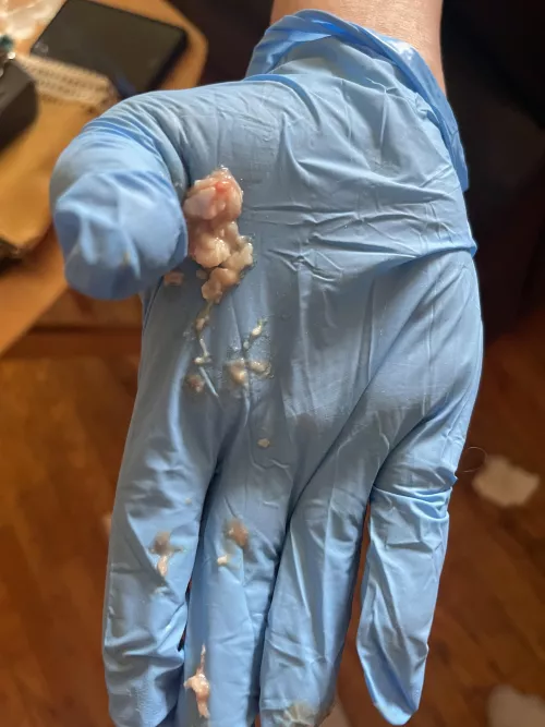 Apparently the doc didn’t drain my cyst all the way by chronicflavors