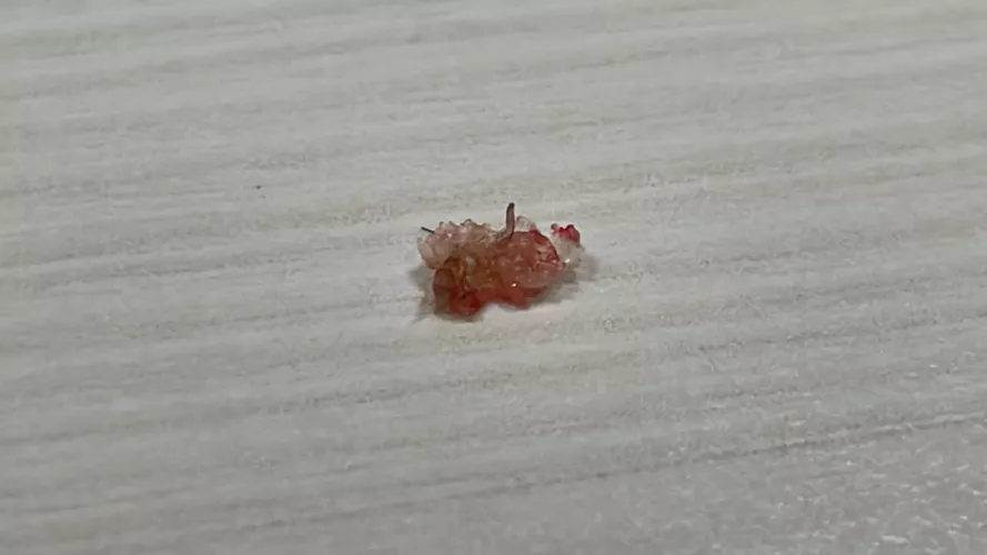 Popped the scab at the back of my head by Twinklebellee