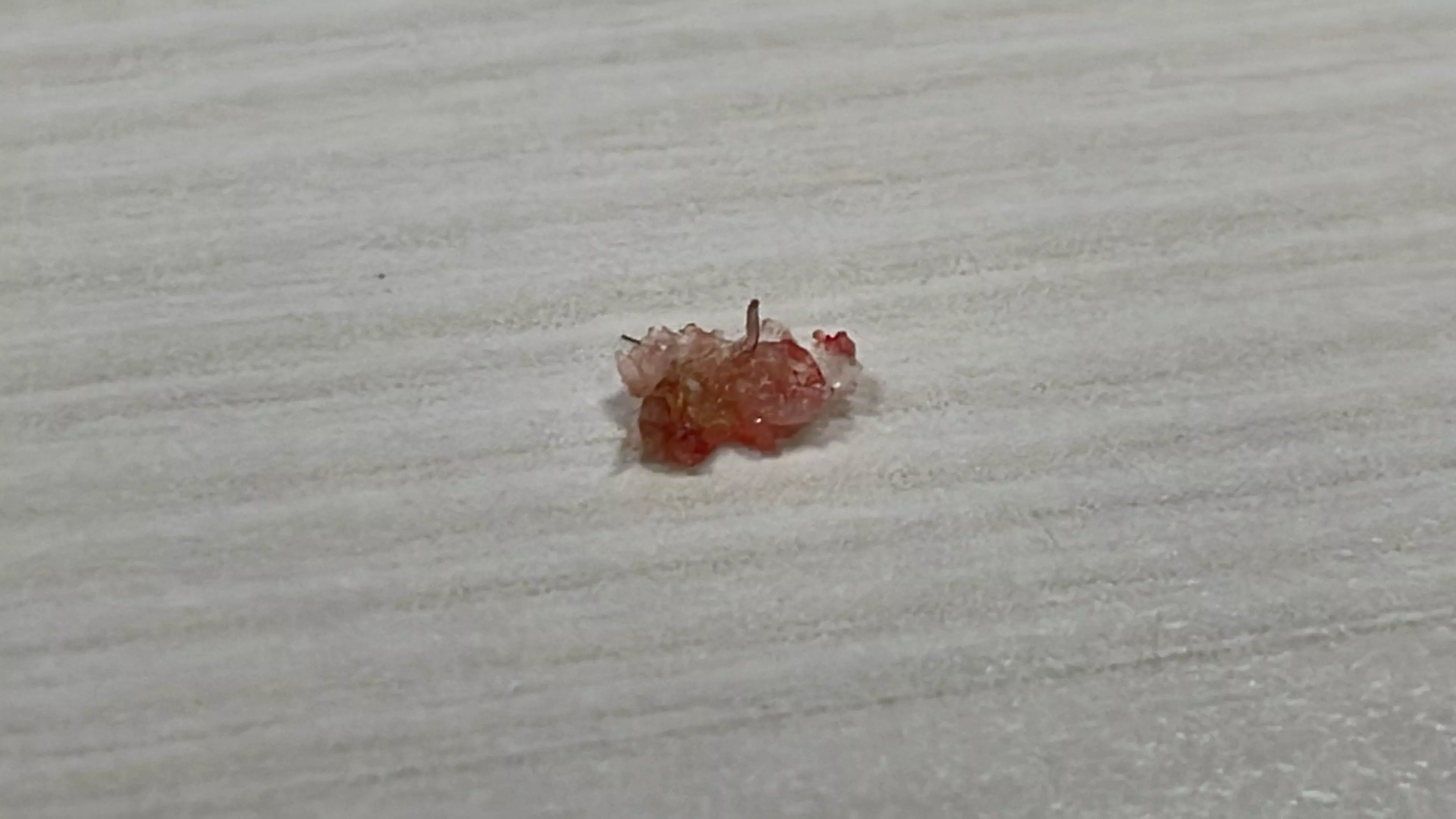 Popped the scab at the back of my head posted by Twinklebellee