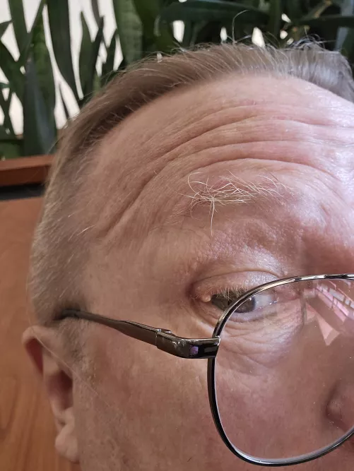 Stye Update, do sending me to specialist Monday. Plugged eyelash folicle. by Vault76exile