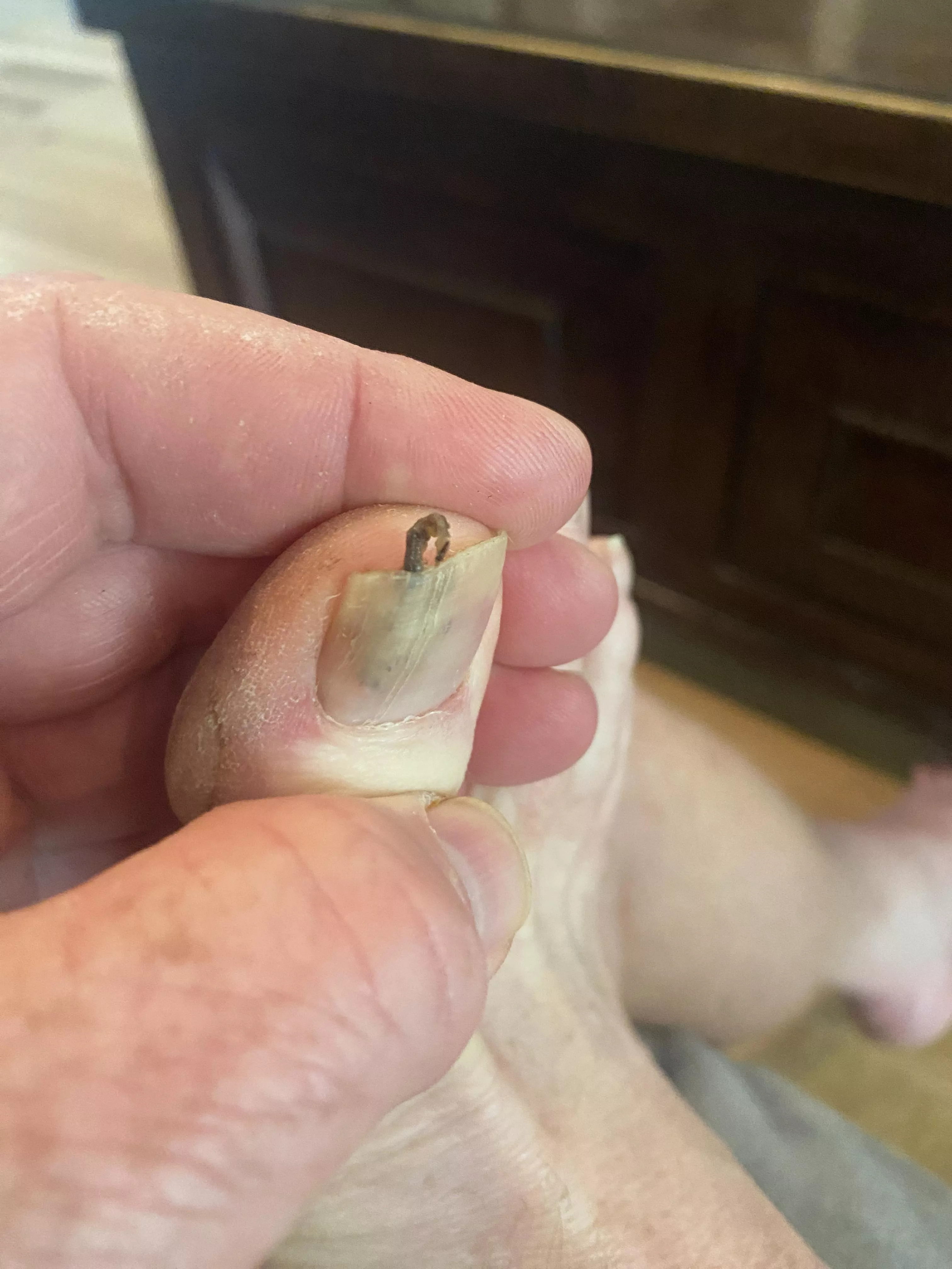 Treating Toenail Fungus. Gave my Toe a Little Squeeze and This Came Out posted by wzl46