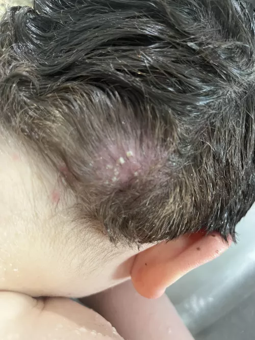 Forbidden pops. My sons psoriasis breakout by 8rittanyy