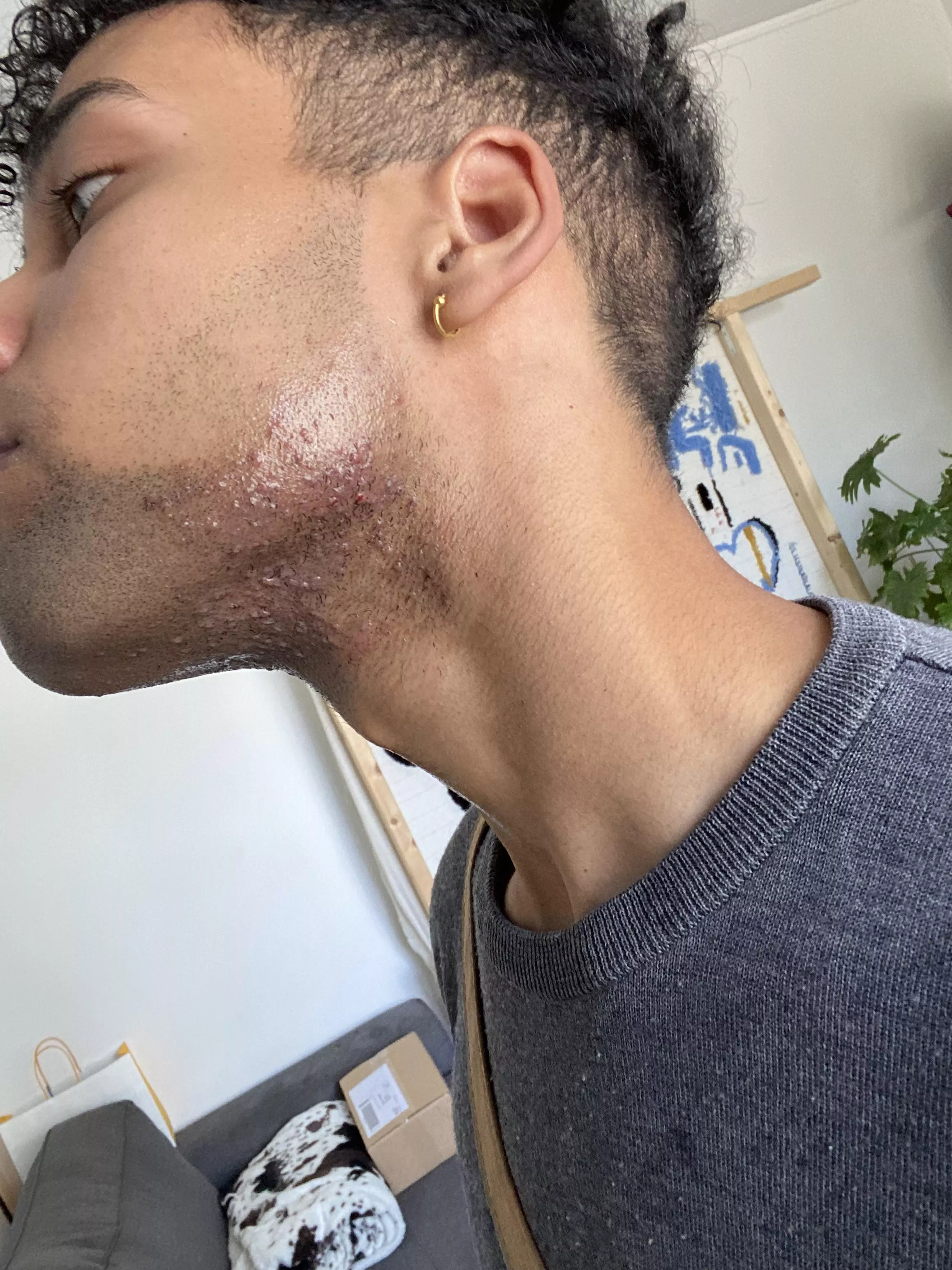 Ingrown hairs and irritations on beard posted by honeyjar20