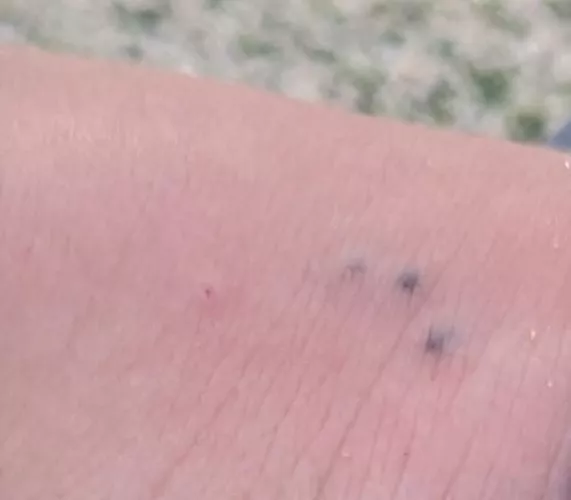 I think my sister stepped on a sea urchin on a beach. We soaked the foot in hot water for now. What should we do? by Wide-Passenger6764