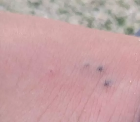 I think my sister stepped on a sea urchin on a beach. We soaked the foot in hot water for now. What should we do? posted by Wide-Passenger6764