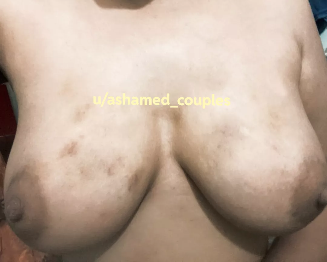 Decided to meet my ex-b(f) secretly but how do i hide my marks now ? posted by Ashamed_Couples