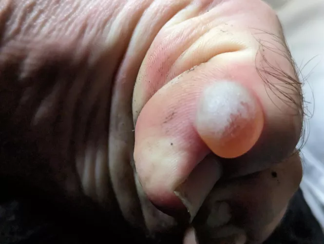 Should I pop this? Hiked for 5 days through mountains by i_piss_perrier