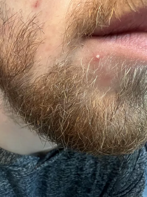 Woke up to this whitehead out of nowhere by HiFi-Munz