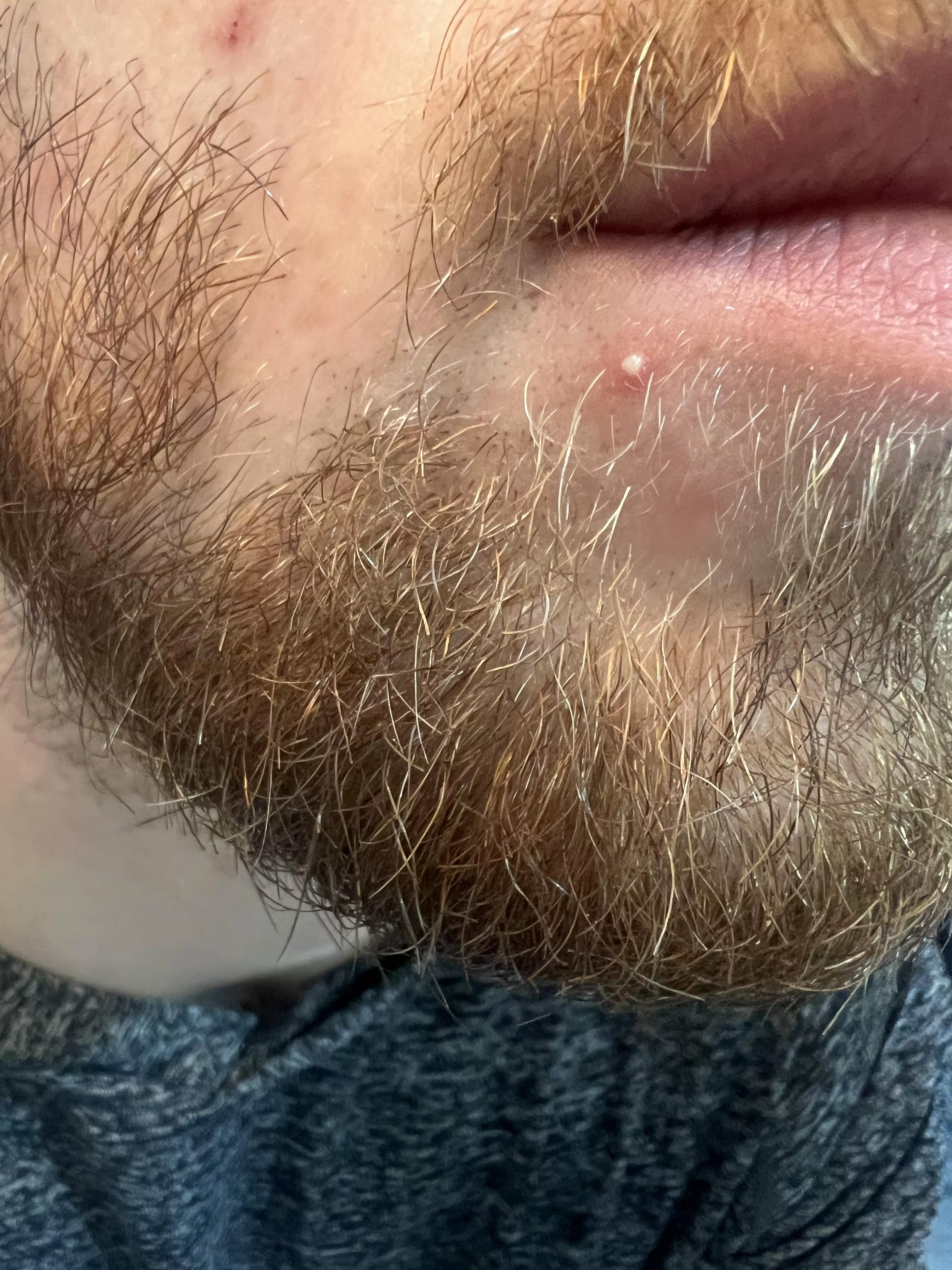 Woke up to this whitehead out of nowhere posted by HiFi-Munz