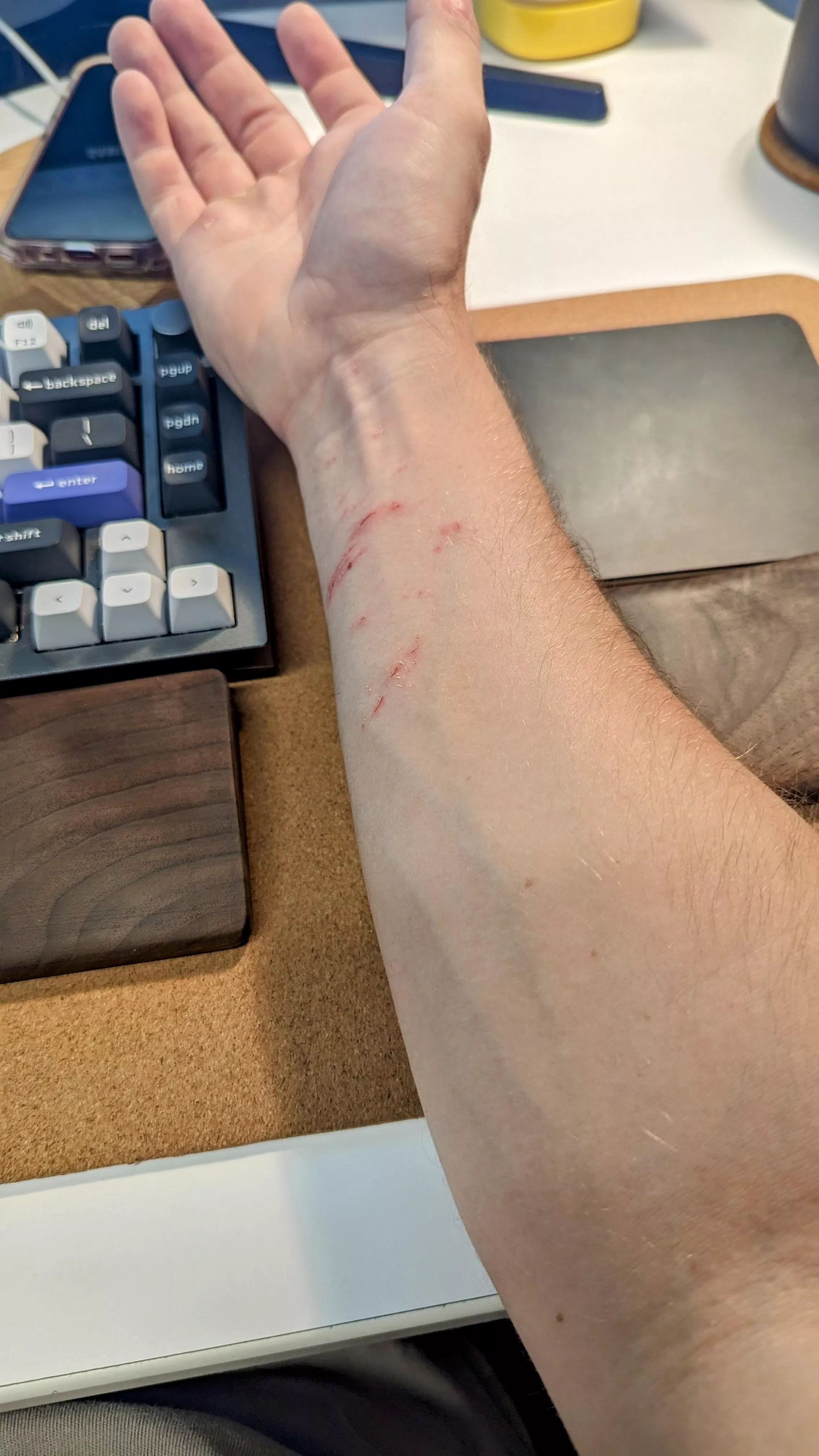 showin' off my booboo in the nsfw forearm sub 💪 posted by beef___str0kin0ff