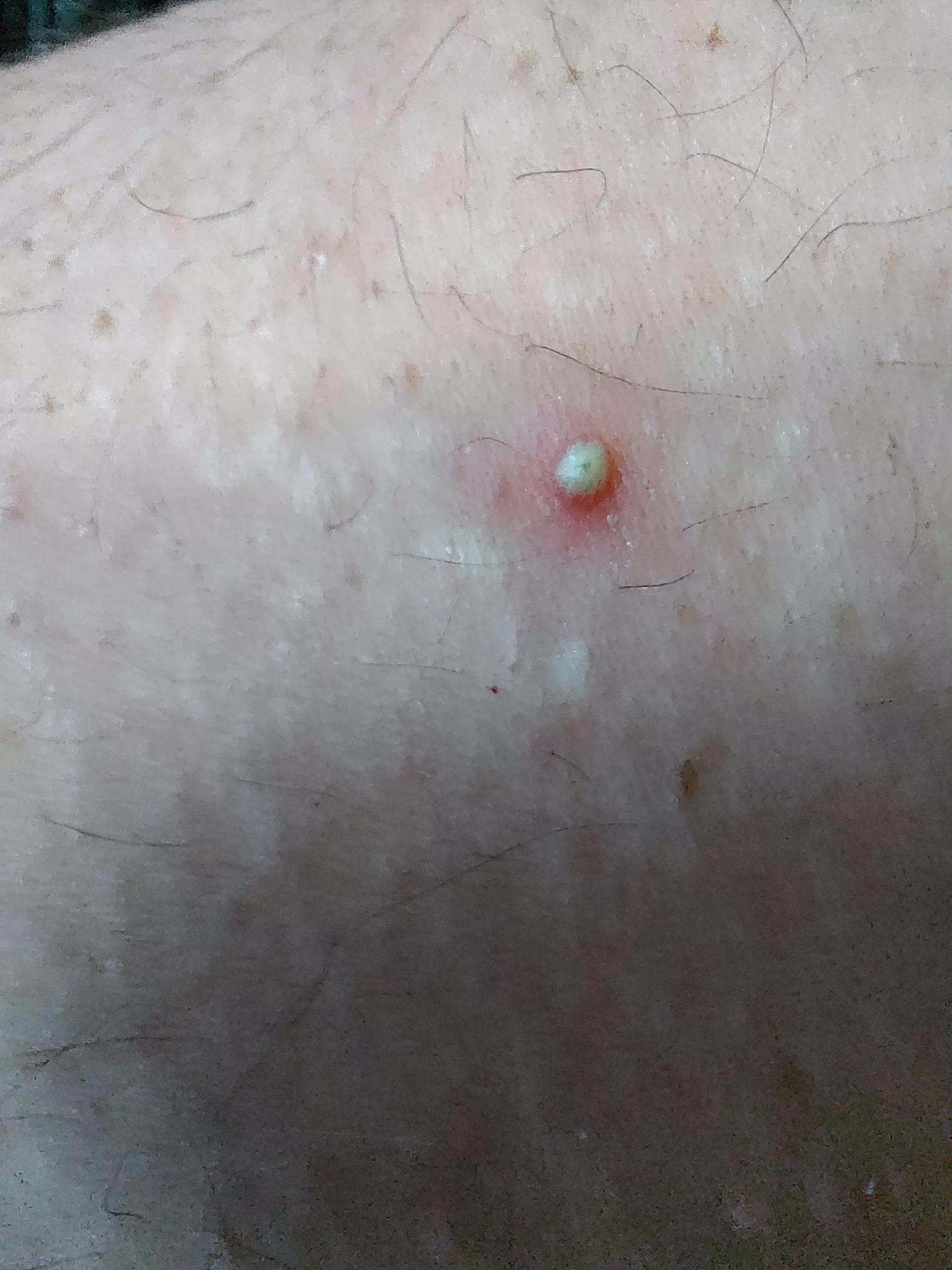 Took my shirt off to get in the shower, this was on my upper arm. posted by hearthcvlt