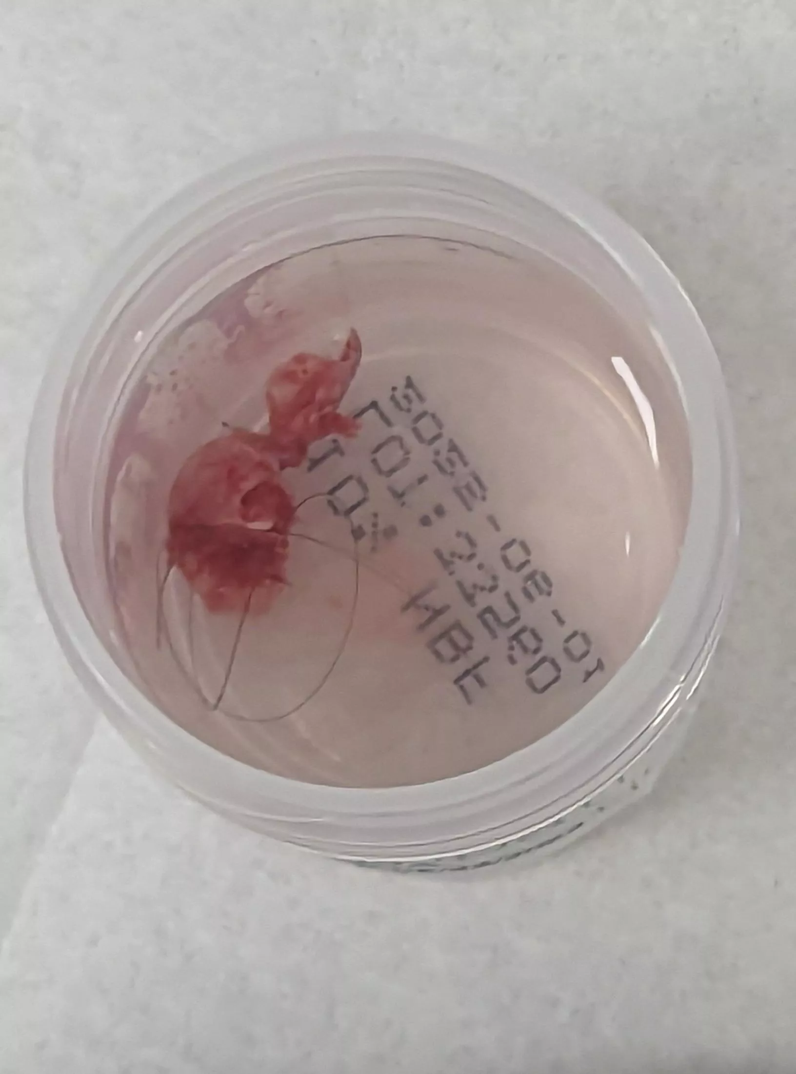 Operation Cease and De-cyst, part VI! posted by That_girL987