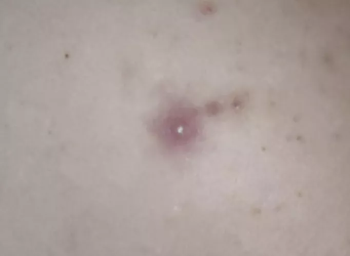 Fiance gets these huge pimples on his back. He lets me try to pop them but they're usually too painful. Waiting for this one to be ready 😅 by InvisiblenMiserable