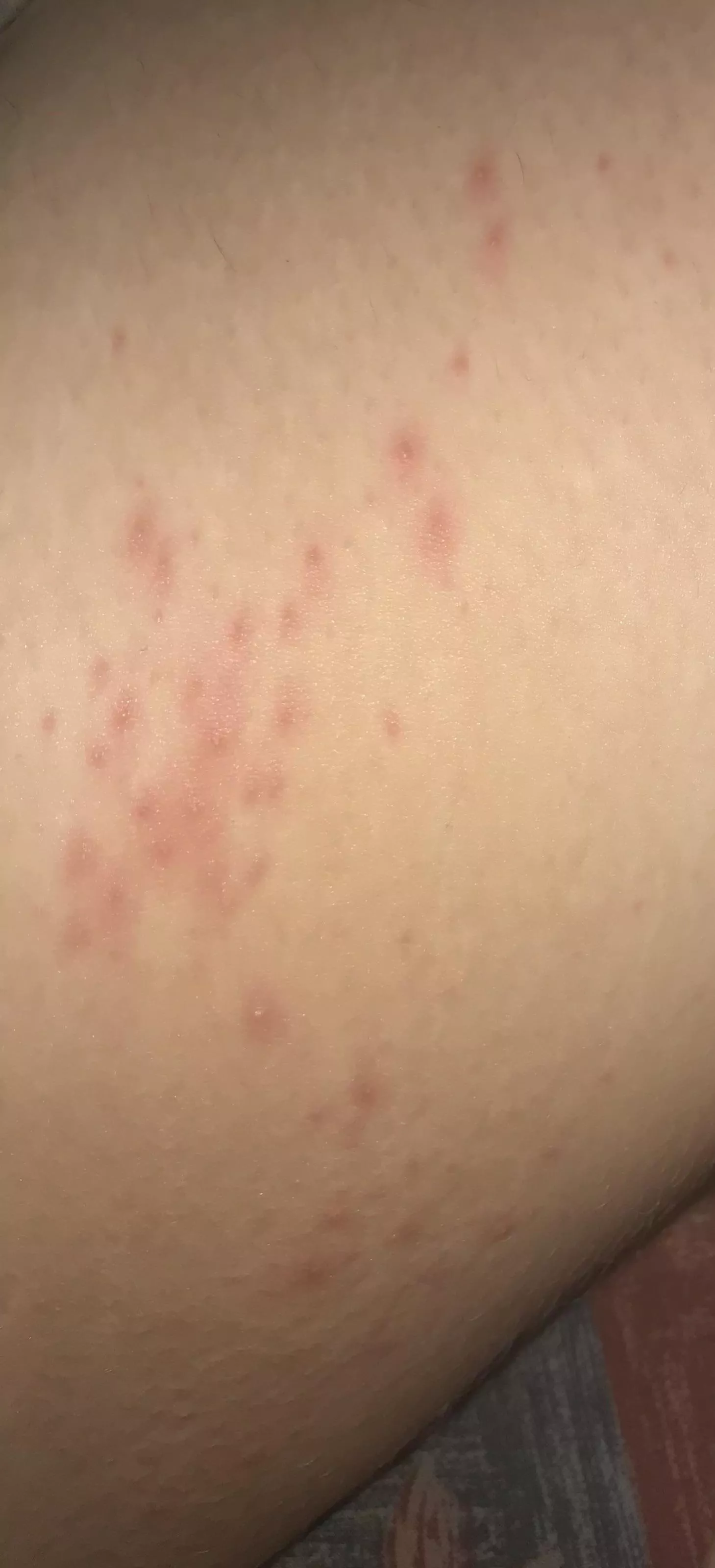 Forbidden pops from chafing posted by Thepolypotato