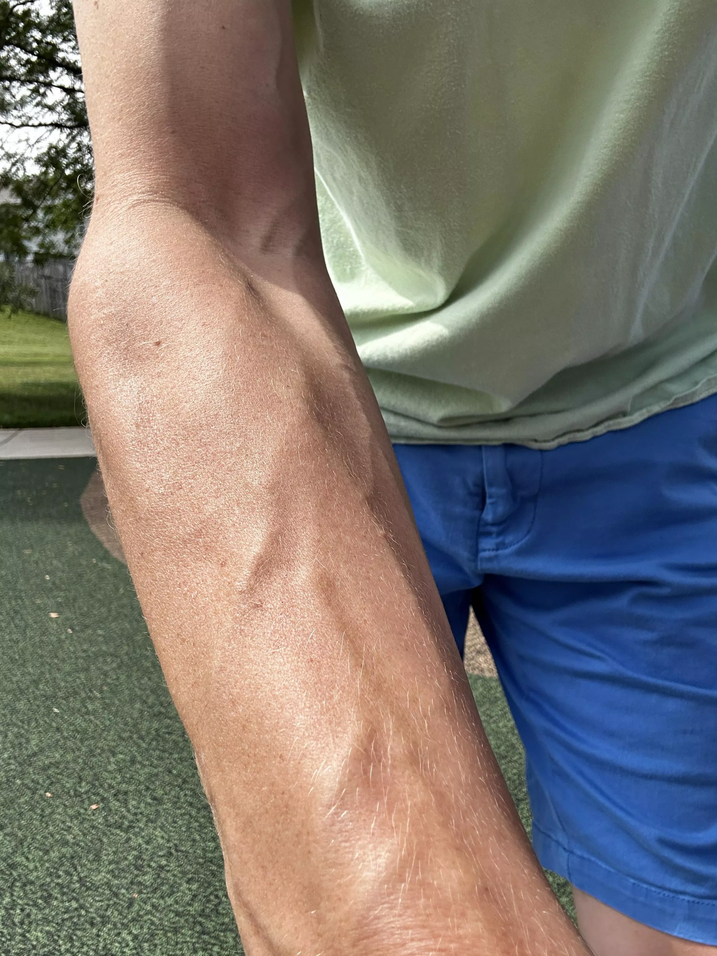 Accidental forearm selfie posted by itsthechadOF