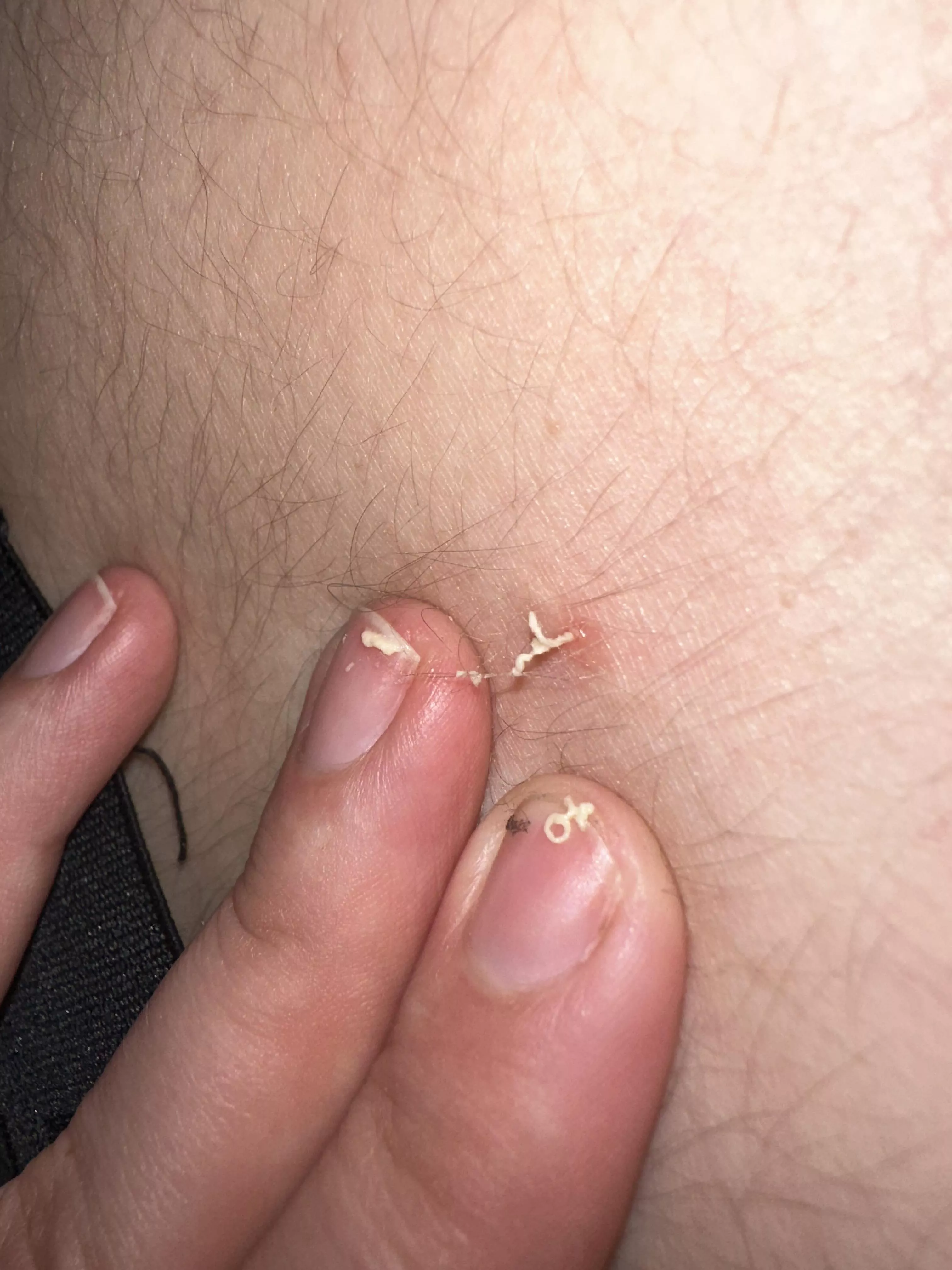 The gift that keeps on giving on my fiance’s lower back….2nd day in a row Ive been able to pop it! posted by srb221