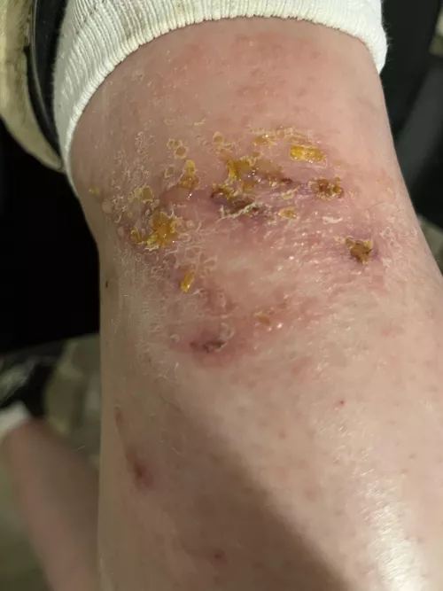 What happens when you pick at and scratch a poison ivy rash. by Slytherinrunner