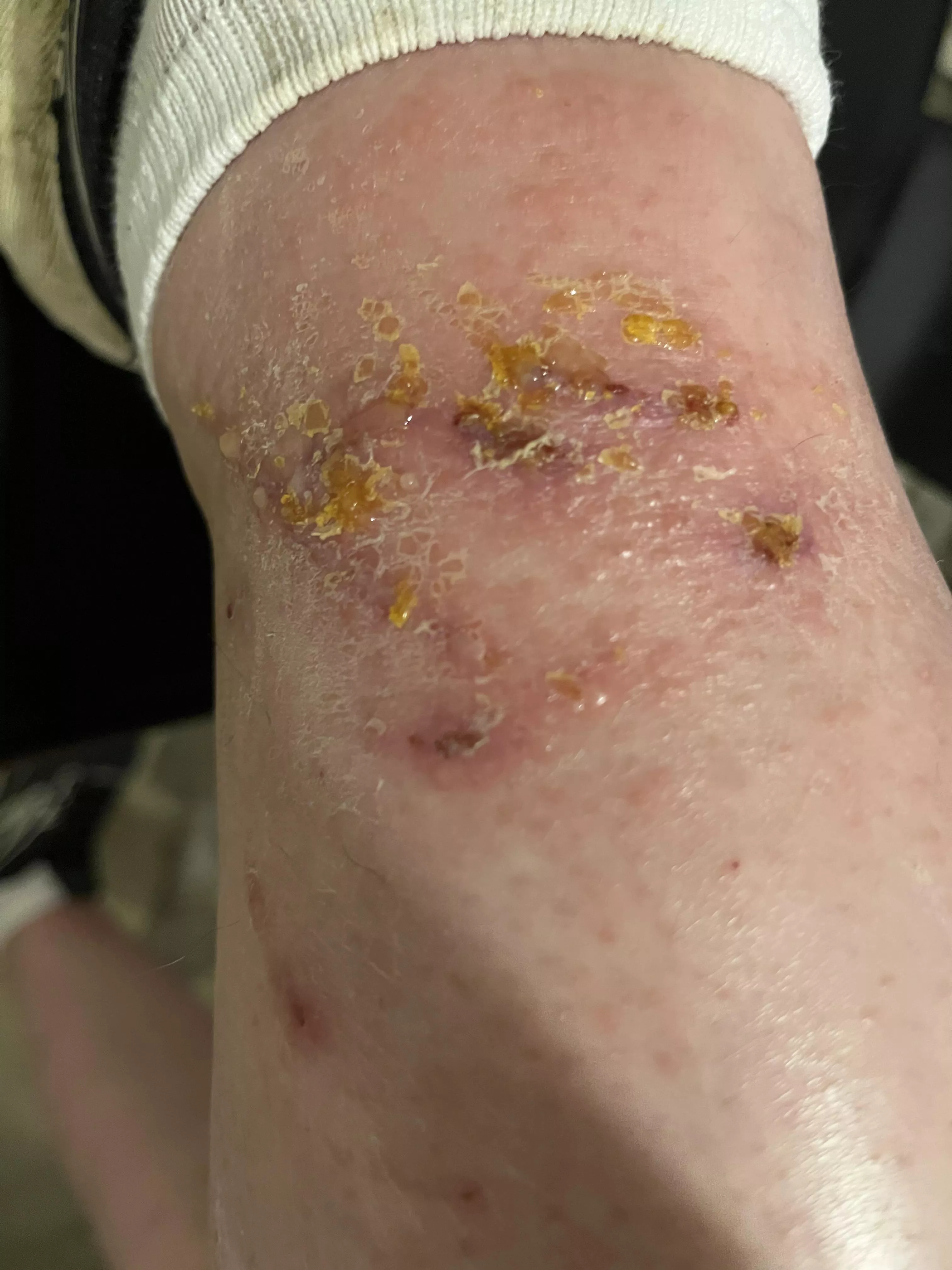 What happens when you pick at and scratch a poison ivy rash. posted by Slytherinrunner