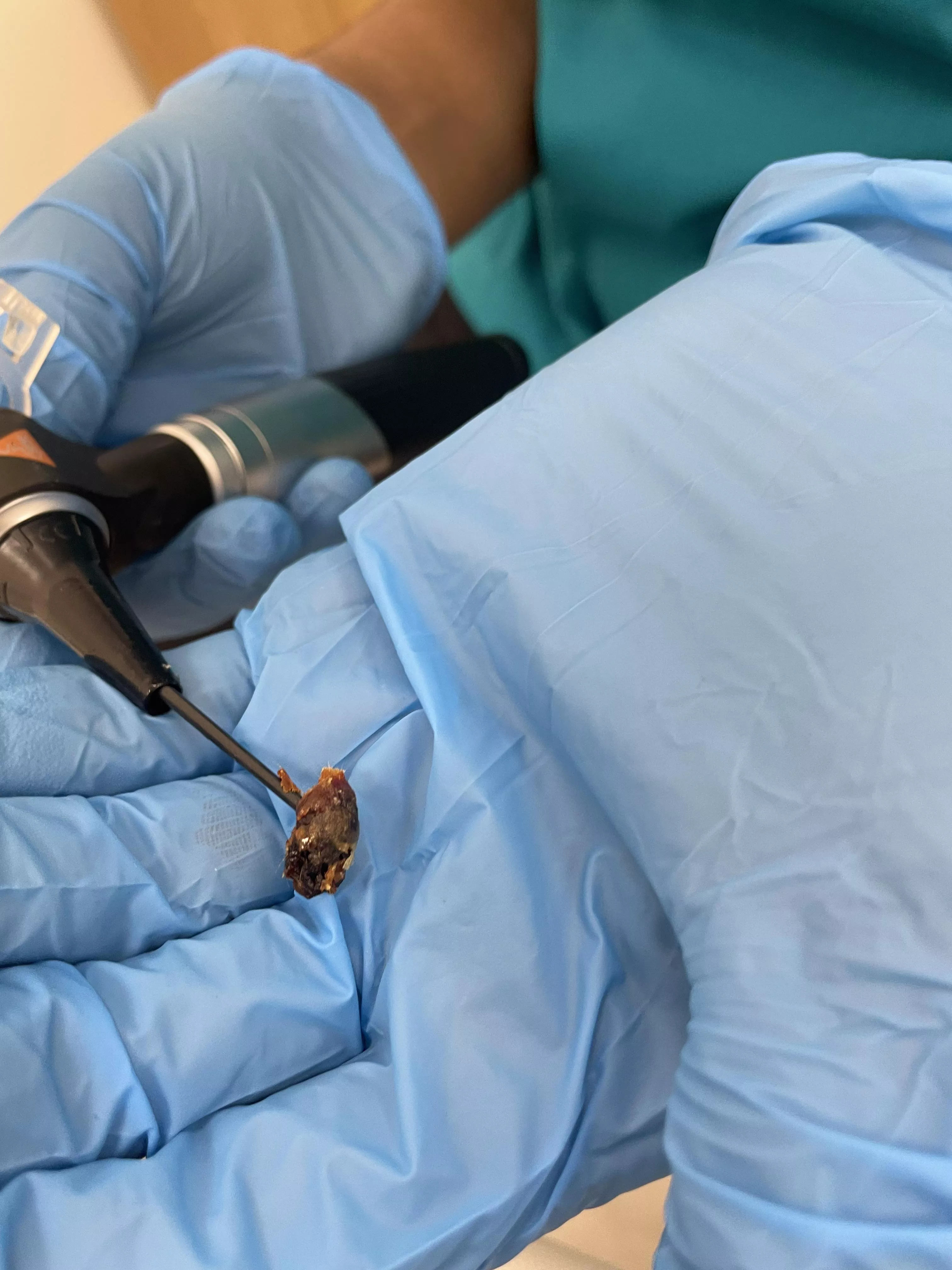 One of the chunks of earwax the nurse removed from my ears today posted by postymcpostpost