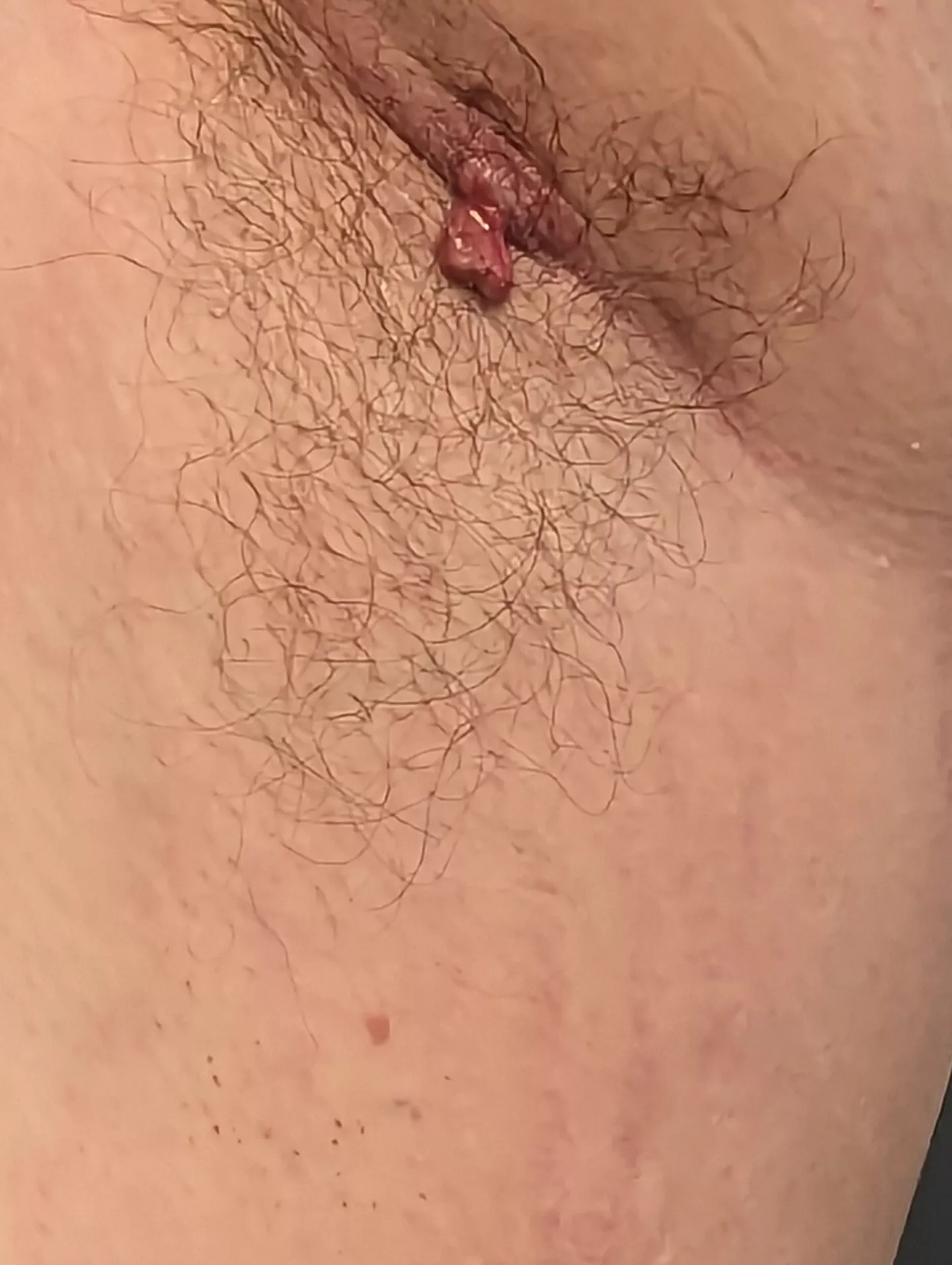 Angry armpit cyst or boil posted by fuzzyrugby