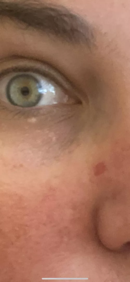 Noticed a pimple of my nose about 1-2 months ago and tried to pop it a few weeks ago. Went to the dermatologist for my annual checkup this week and turns out, that “pimple” is actually basal cel carcinoma. I popped my skin cancer. (Pic is after the b by blurbies22