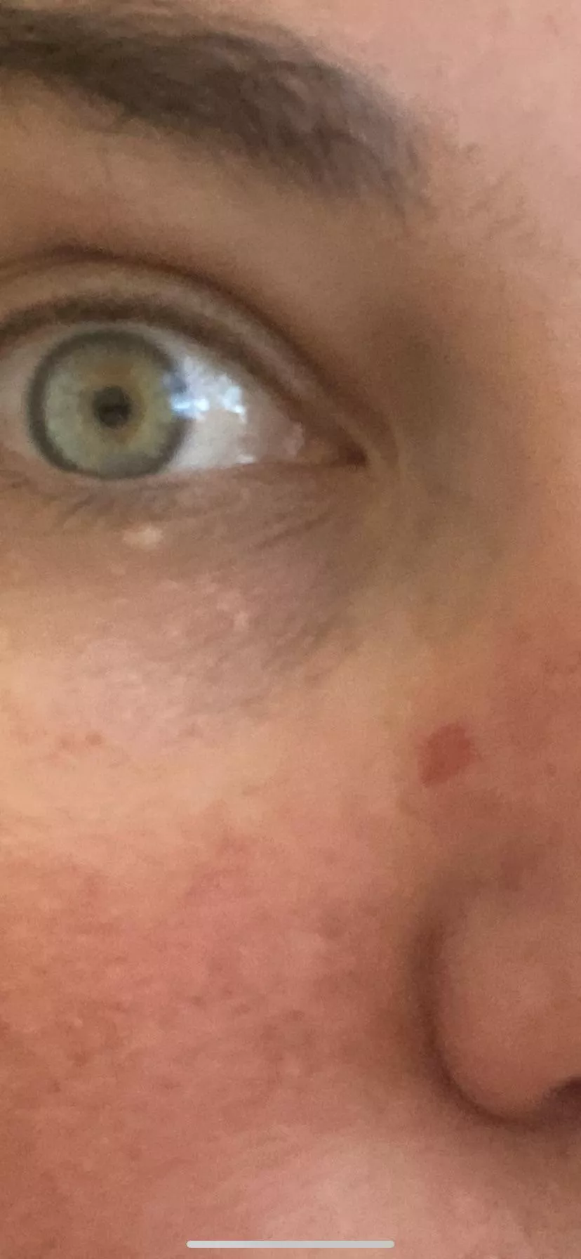 Noticed a pimple of my nose about 1-2 months ago and tried to pop it a few weeks ago. Went to the dermatologist for my annual checkup this week and turns out, that “pimple” is actually basal cel carcinoma. I popped my skin cancer. (Pic is after the b posted by blurbies22