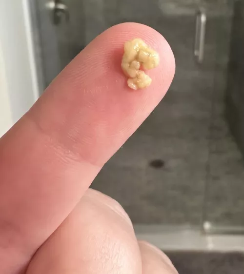 (OC) Big ole tonsil stone by Pickled_pepper_