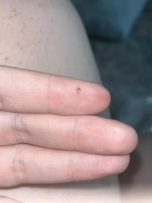 popped this from the back of my calf. i’ve never had a blackhead like this there before by endofthefkingworld
