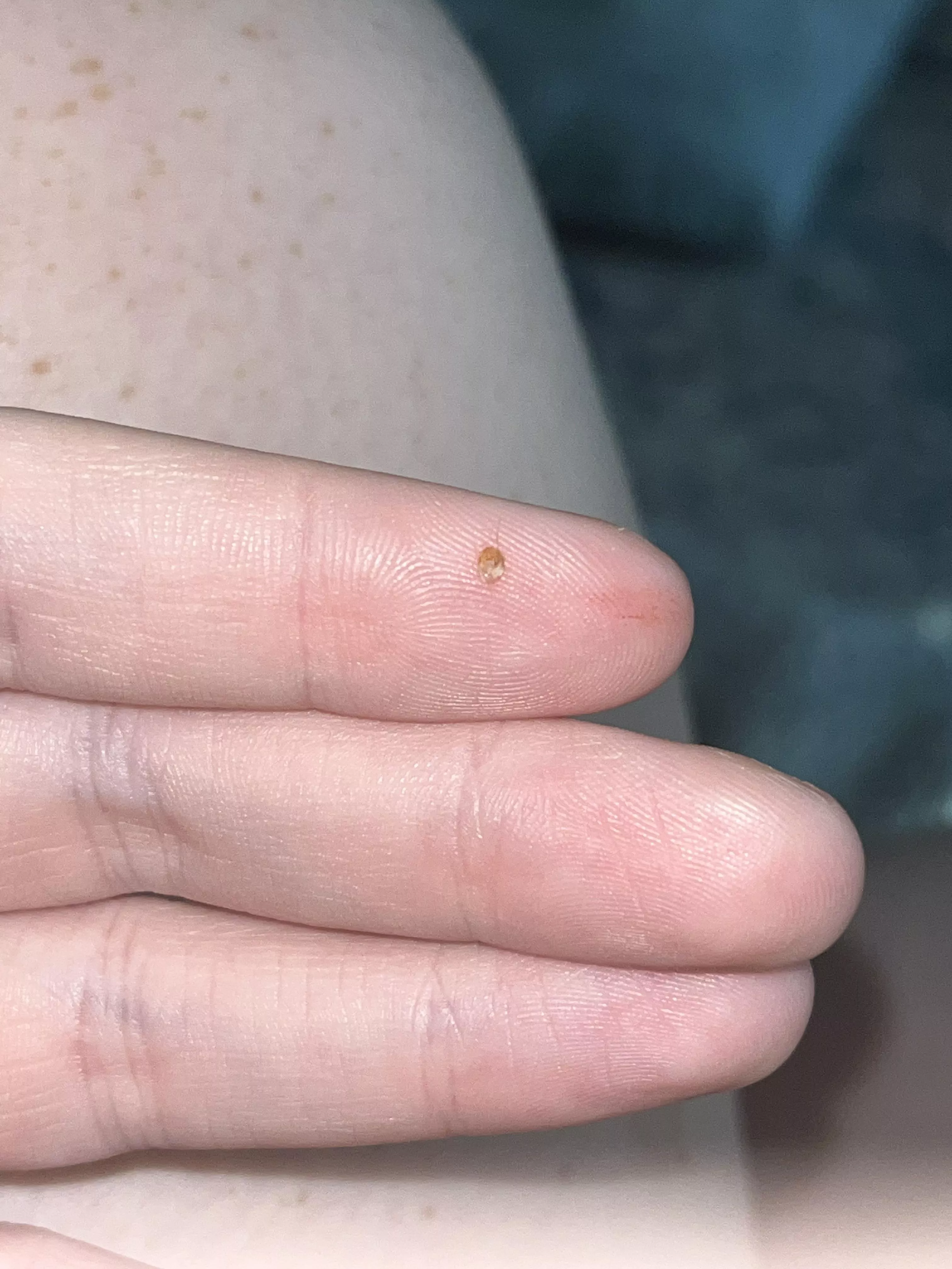popped this from the back of my calf. i’ve never had a blackhead like this there before posted by endofthefkingworld