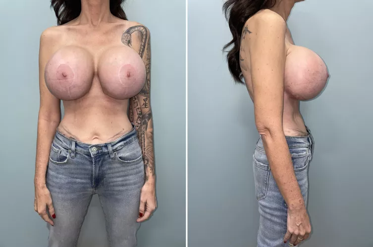 Skinny with huge addons by garry_lejeune