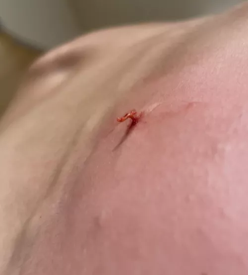 Vellus hair cyst popped by etkalafut