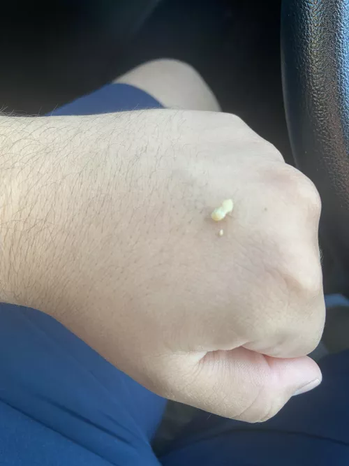 Absolute unit that came out of my tonsils. by pedrooftomorrow