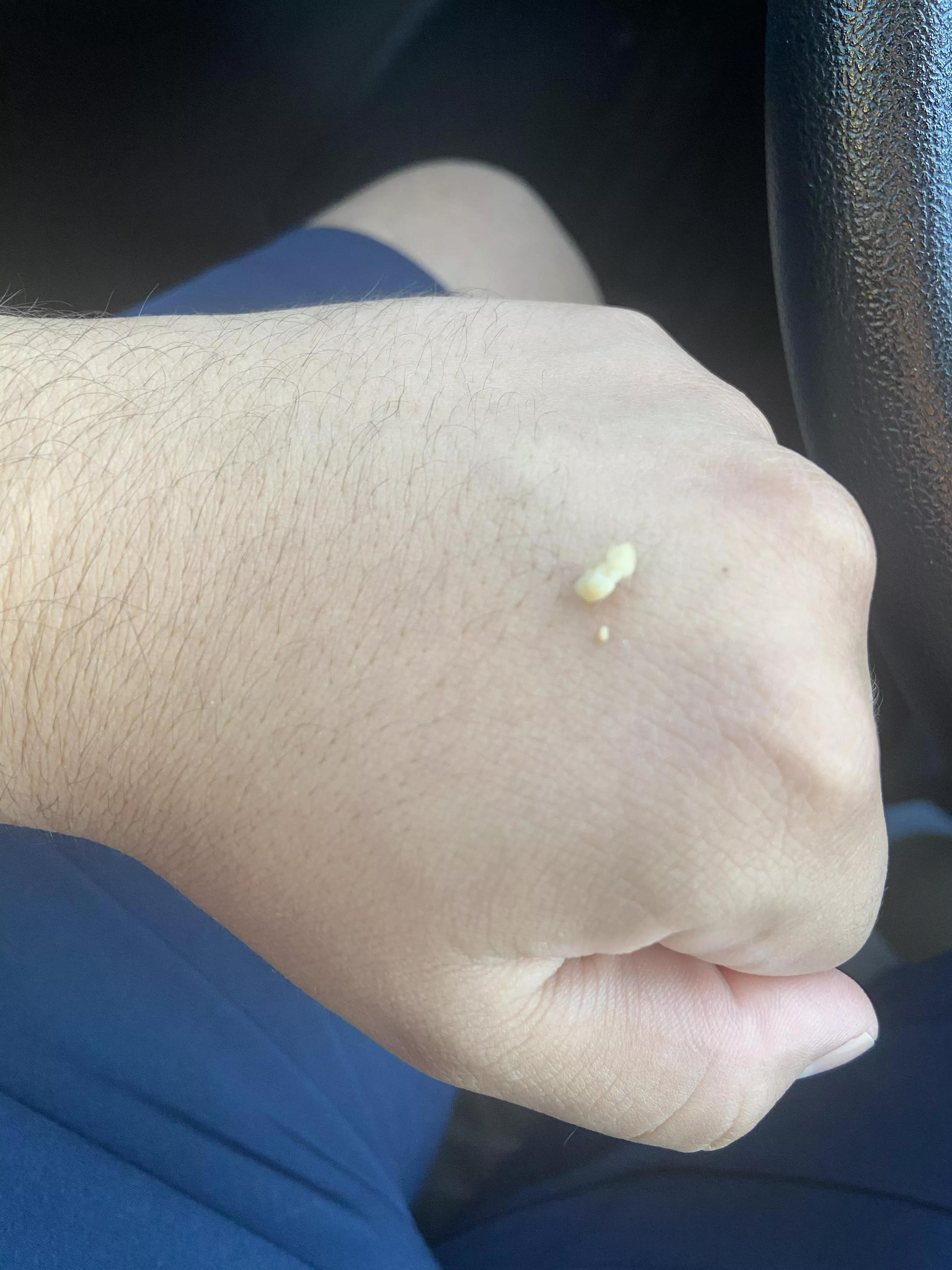 Absolute unit that came out of my tonsils. posted by pedrooftomorrow
