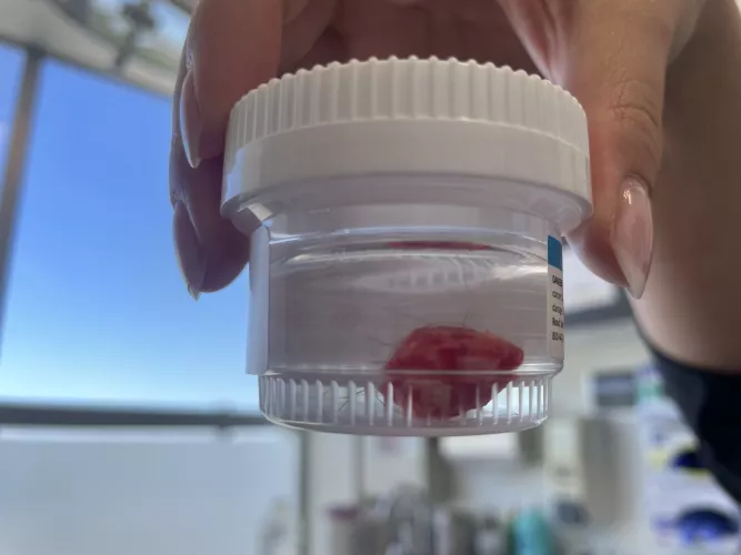 Pilar Cyst Removed on my scalp by chief_slurpee