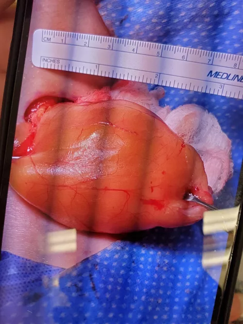 Big lipoma removed by my neck by lilscarchi