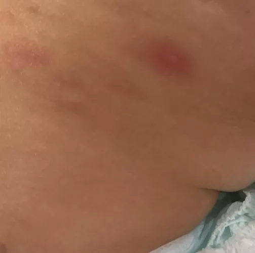 How many days do abscess continue feeling hard and a little red after draining ? by Training_Solution_37