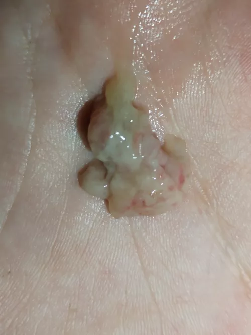 Just blew this bad boy out of my nose. Feels like a piece of my brain came out by wtfisthiseven1313