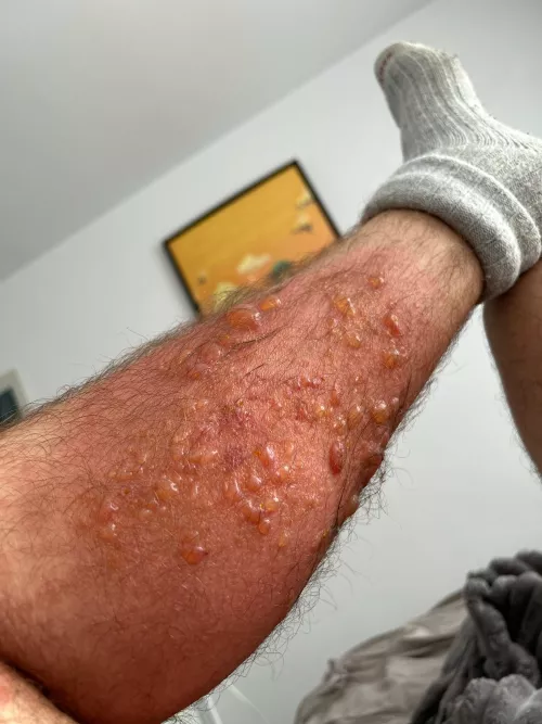 Sick and tired of poison ivy by Bigthom63