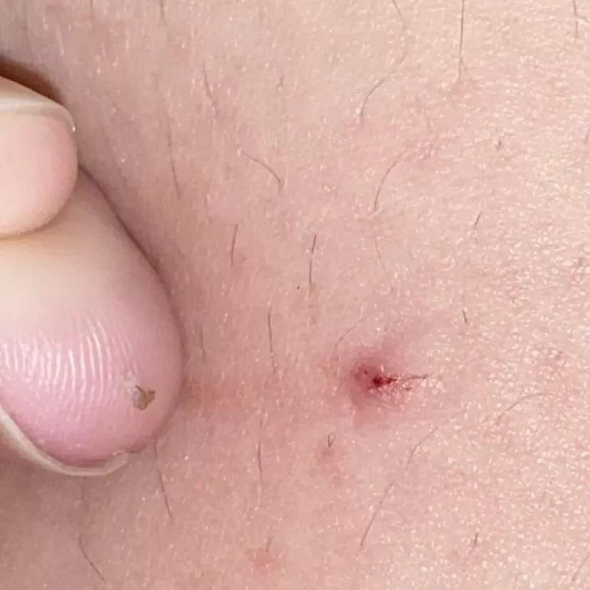 This ingrown hair I popped out of my thigh posted by kimikimikei