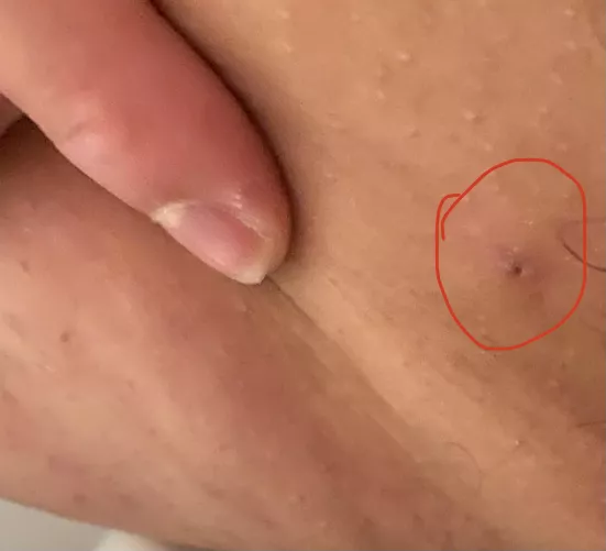 Fellas I found what I think is a giant pimple (it feels bigger than it looks) on my inner thigh. Problem is; how tf do I film it? by Aqua7KH
