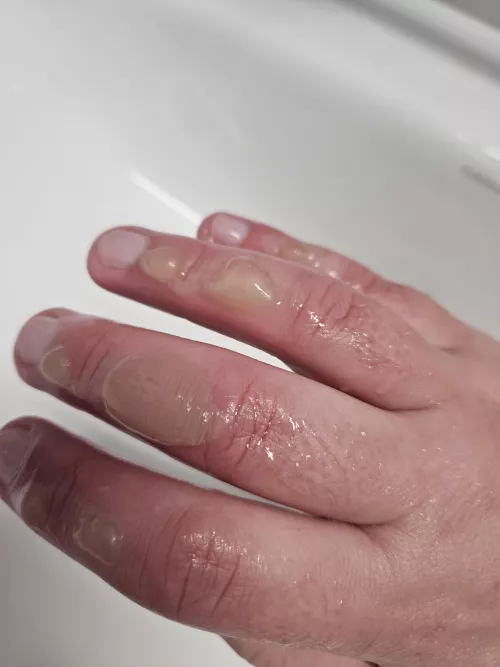 First time poster. Burnt my fingies on a metal tray, fresh out of the oven at work by LoganBassist