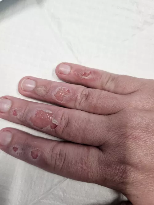 Update on the burnt fingies by LoganBassist