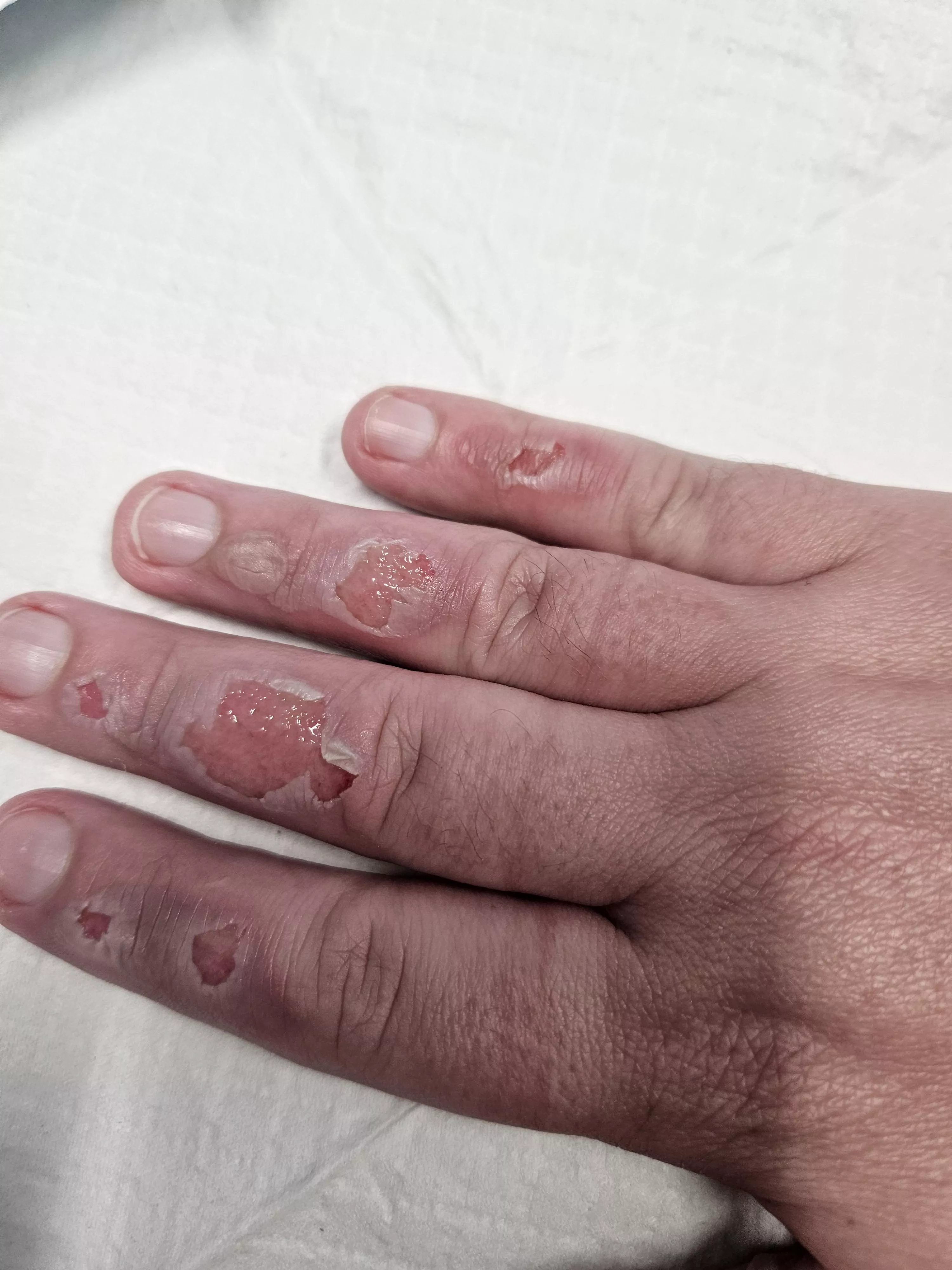 Update on the burnt fingies posted by LoganBassist