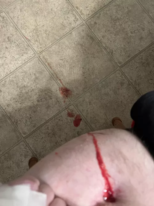 Osteomyelitis surprise explosion on my hip which flew a few feet. Photo only since I wasn’t expecting it lol. NSFW just because of upper thigh, no nudity. by mfdoorway