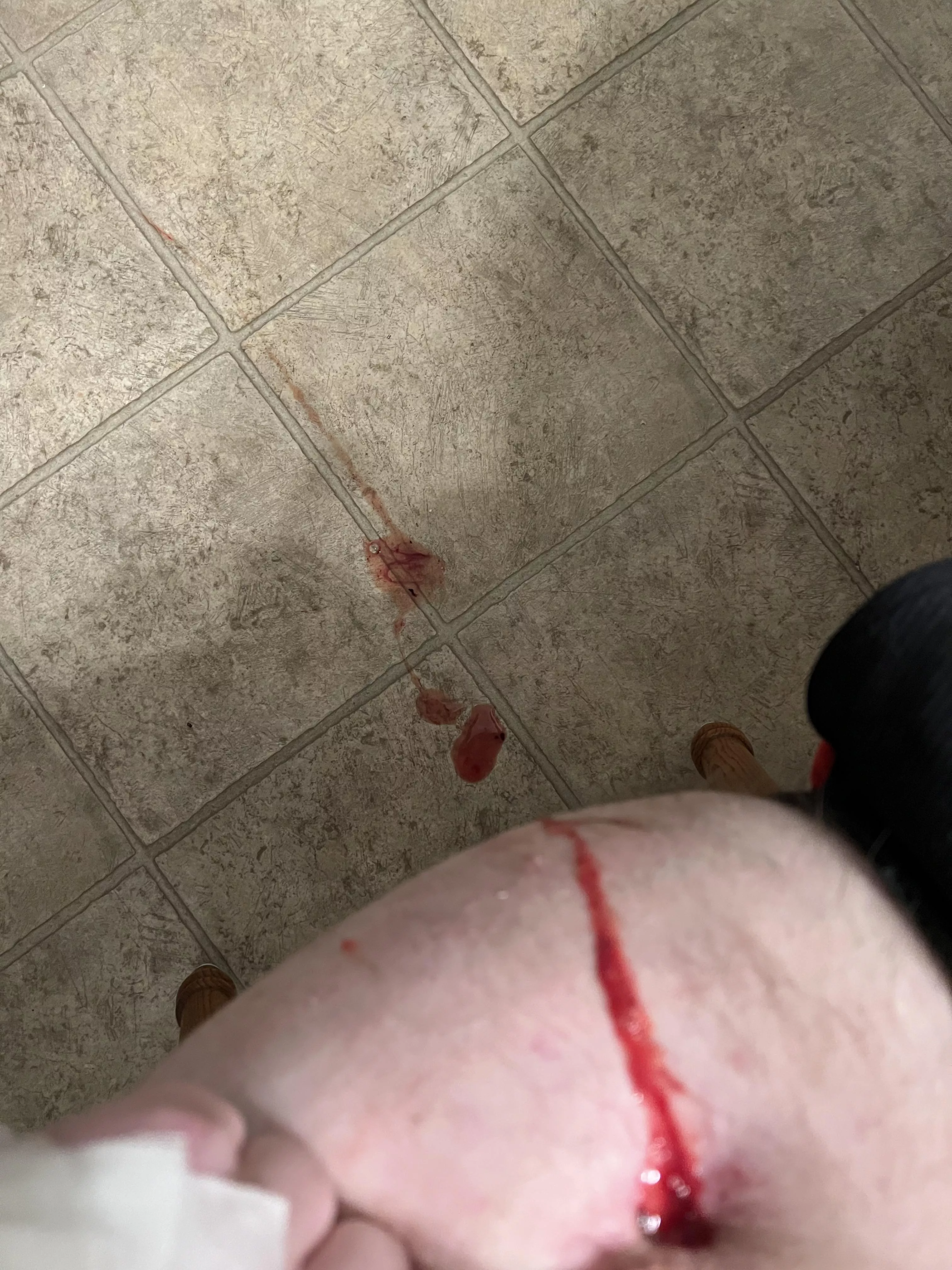 Osteomyelitis surprise explosion on my hip which flew a few feet. Photo only since I wasn’t expecting it lol. NSFW just because of upper thigh, no nudity. posted by mfdoorway