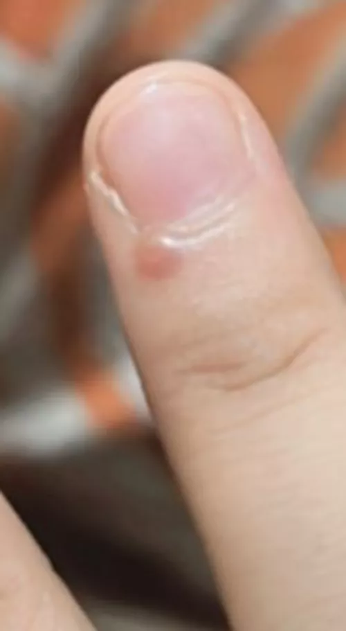 what's this small bump? it aches by Xulqarnaen